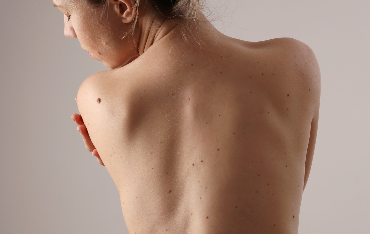 DIAGNOSTYKA ZNAMION – CZYM SĄ ZNAMIONA I JAK JE BADAĆ! Okiem dermatologa dra Łukasza Preibisza