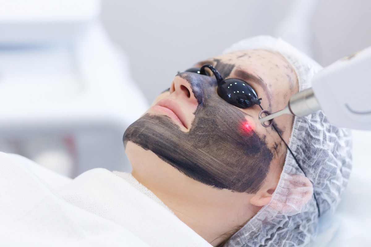 laserowy peeling węglowy