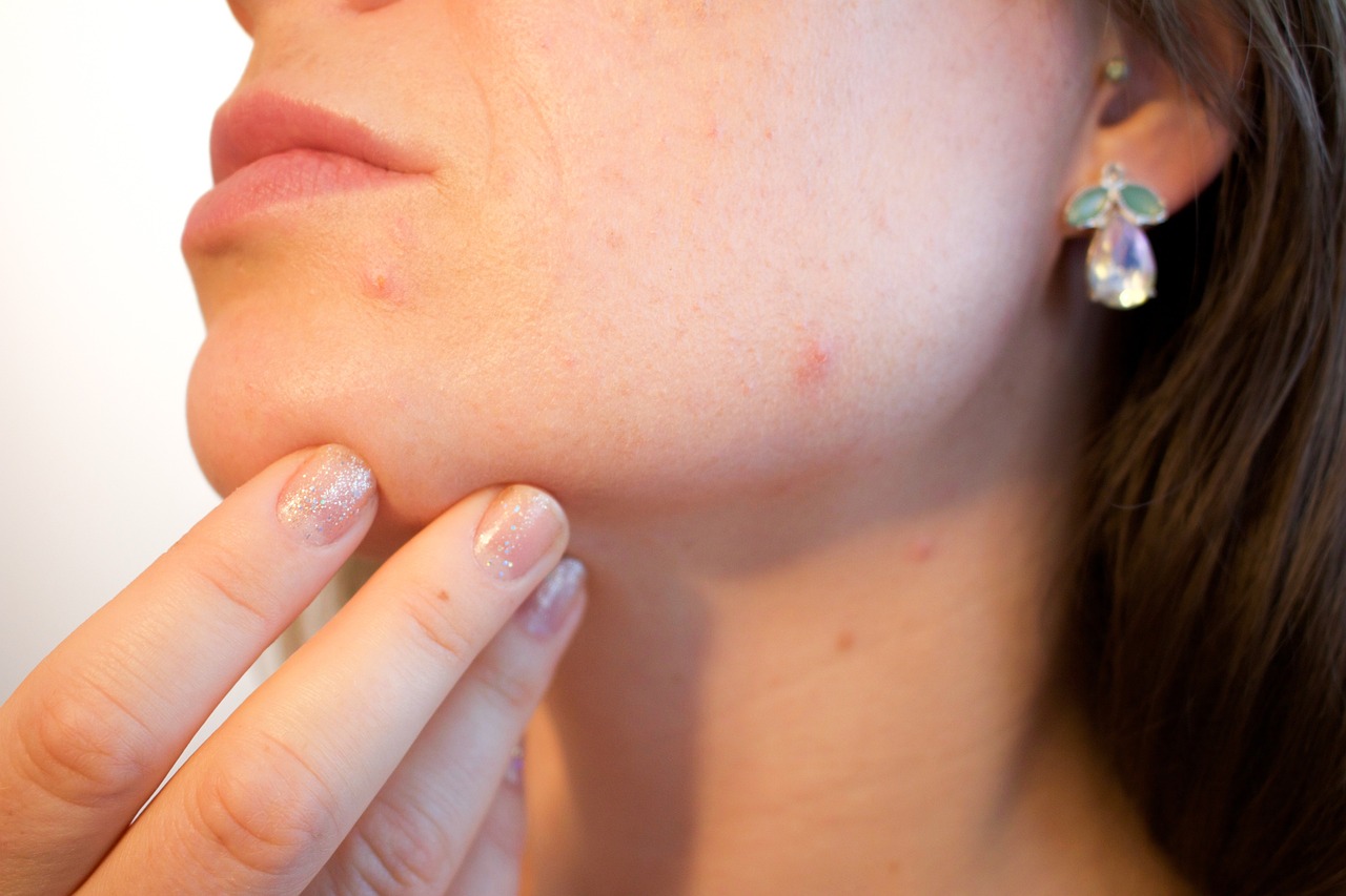 zobacz jakie są przyczyny trądziku hormonalnego
