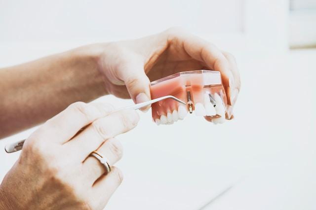 implanty zębów na modelu szczęki