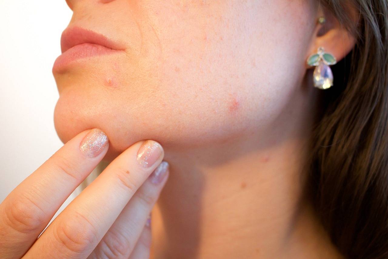 acne 1606765 1280 wp