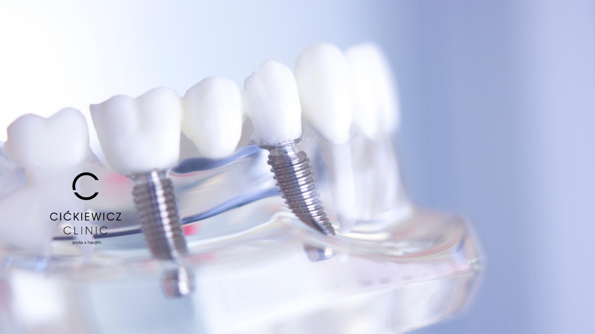 Implanty Warszawa w Cićkiewicz Clinic – nowoczesne rozwiązanie dla trwałego i estetycznego uśmiechu