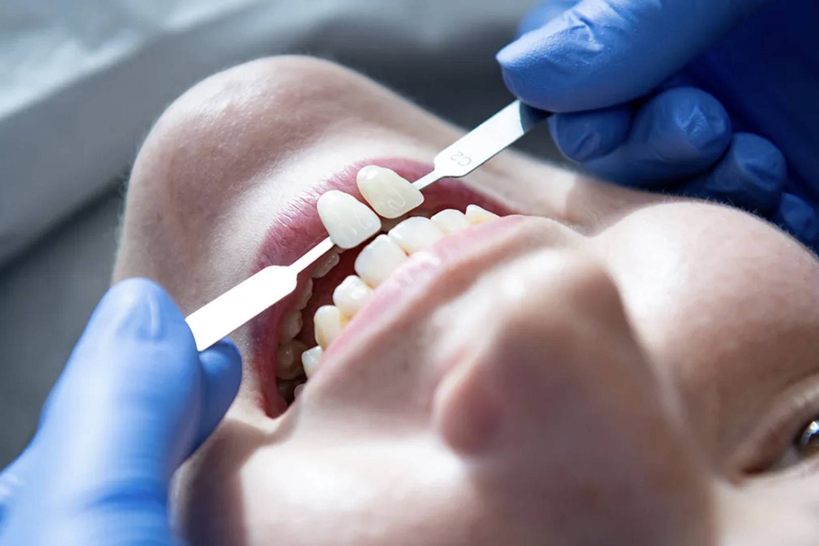 Na czym polega bonding zębów i czym różni się od licówek?