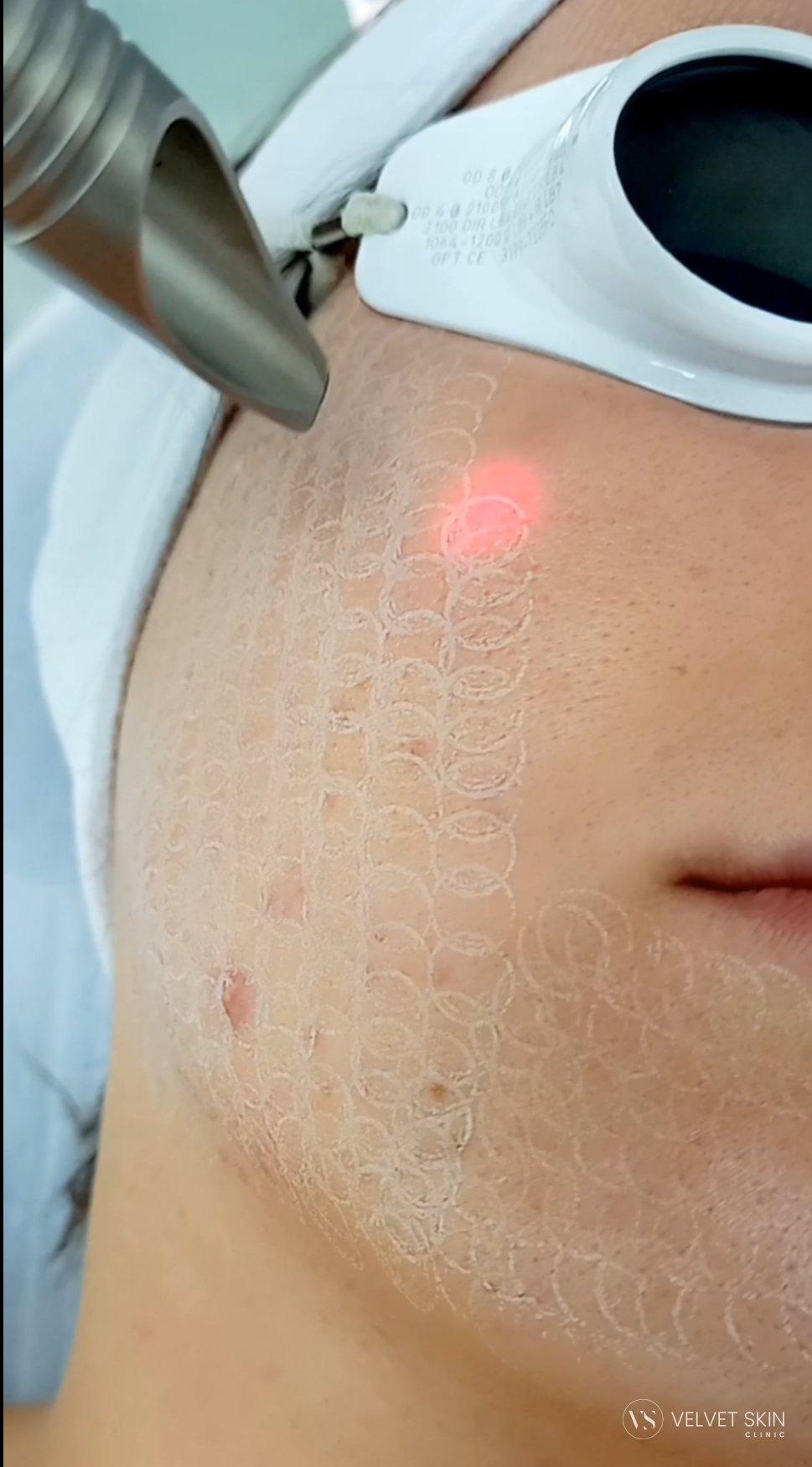 Blizna nie musi zostać na zawsze taka sama. Co dziś potrafi laser