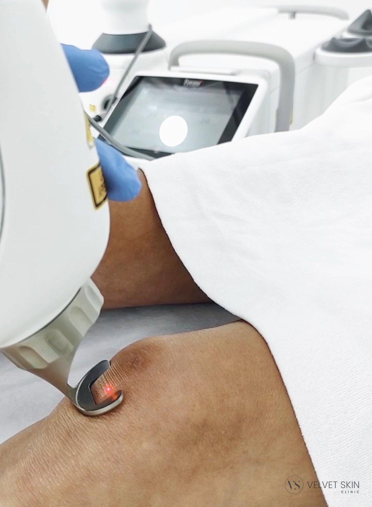 laser-fotona-zabieg-blizny-kolano-velvet-skin-clinic