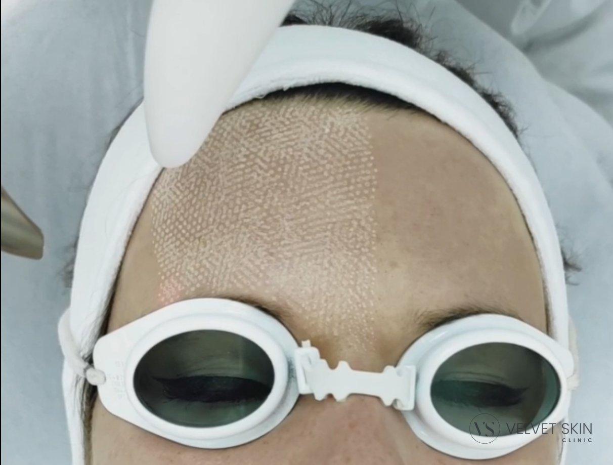 laser-frakcyjny-czolo-fotona-velvet-skin-clinic