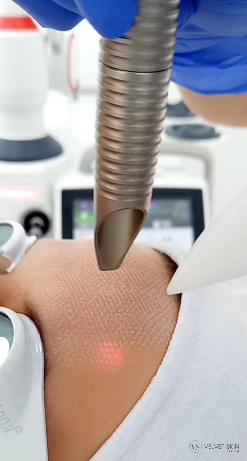 laserowy-zabieg-skory-twarzy-velvet-skin-clinic